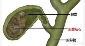 今日科普一下！胆囊藏400多颗结石,百科词条爱好_2024最新更新