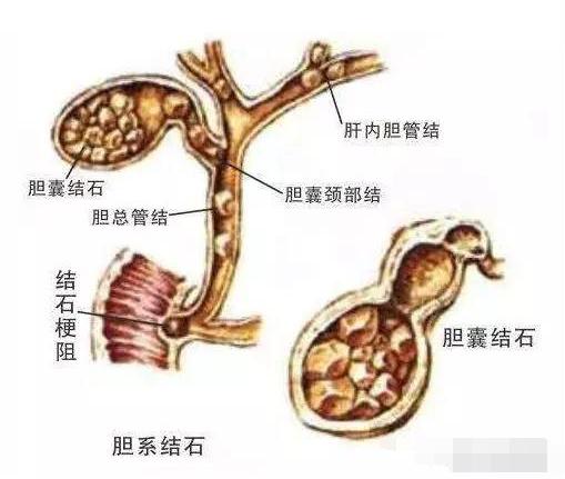 今日科普一下！胆囊藏400多颗结石,百科词条爱好_2024最新更新