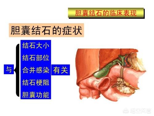 今日科普一下！胆囊藏400多颗结石,百科词条爱好_2024最新更新