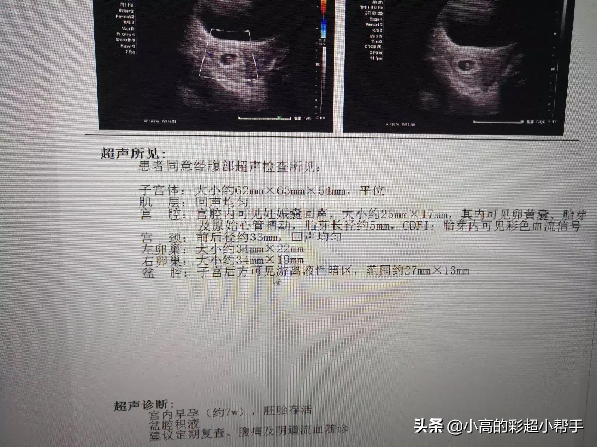 今日科普一下！怀孕8周找不到胎儿,百科词条爱好_2024最新更新